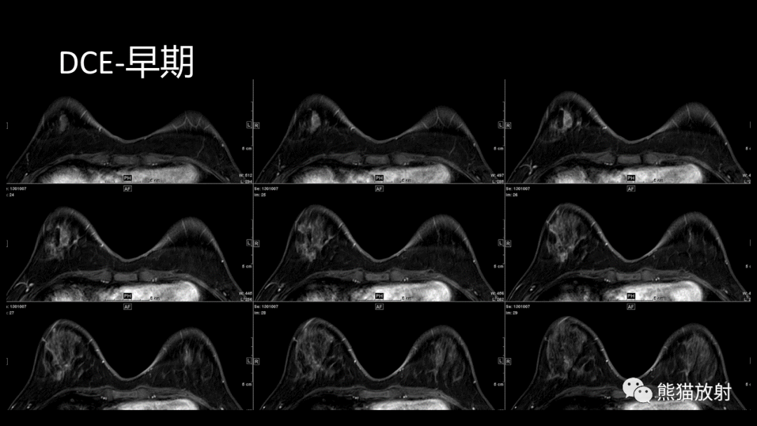 影像PPT - 【病例】乳腺粘液癌2例MR影像-6