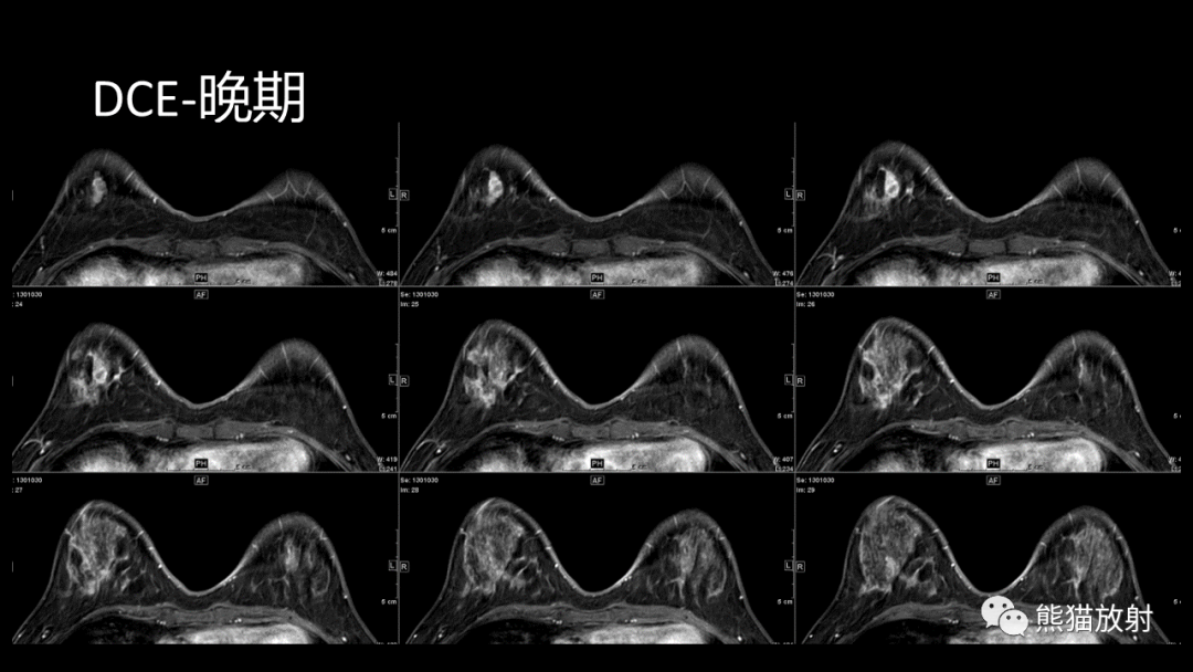 影像PPT - 【病例】乳腺粘液癌2例MR影像-7