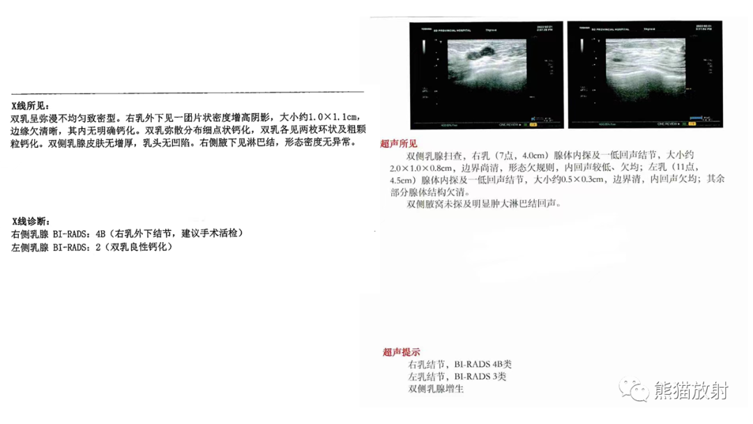 影像PPT - 【病例】乳腺粘液癌2例MR影像-11