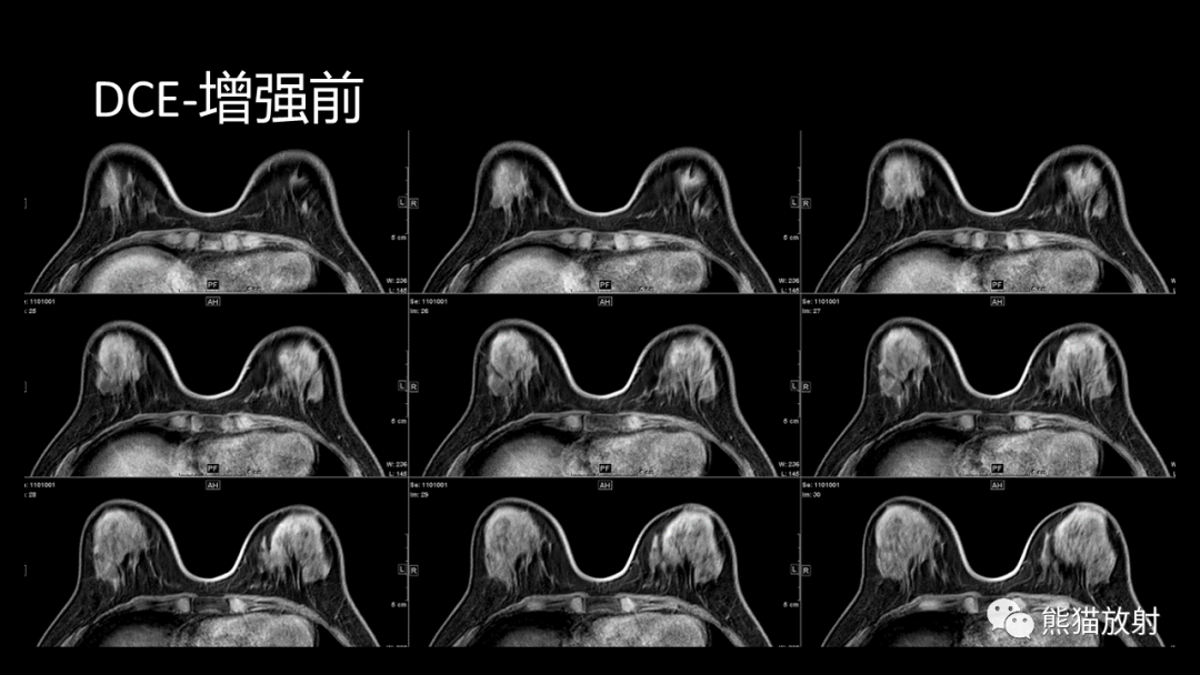 影像PPT - 【病例】乳腺粘液癌2例MR影像-13