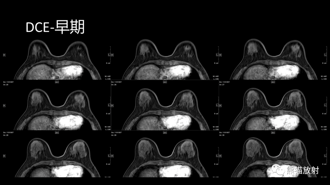 影像PPT - 【病例】乳腺粘液癌2例MR影像-14