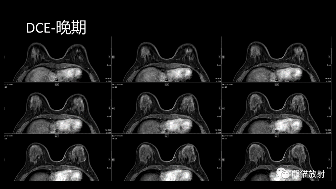 影像PPT - 【病例】乳腺粘液癌2例MR影像-15