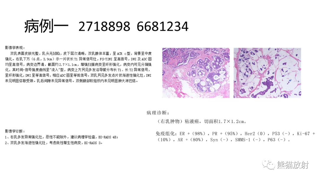 影像PPT - 【病例】乳腺粘液癌2例MR影像-17