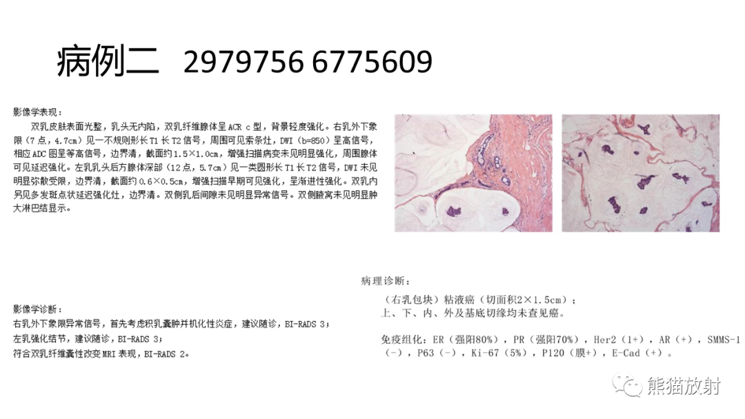 影像PPT - 【病例】乳腺粘液癌2例MR影像-18