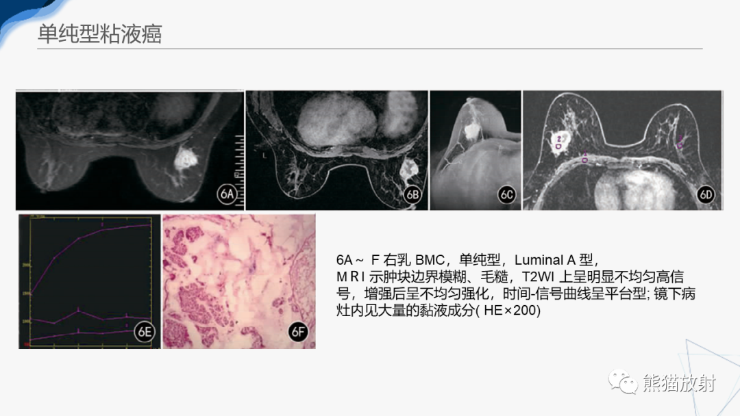 影像PPT - 【病例】乳腺粘液癌2例MR影像-29