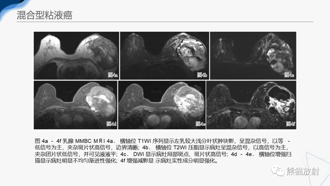 影像PPT - 【病例】乳腺粘液癌2例MR影像-30