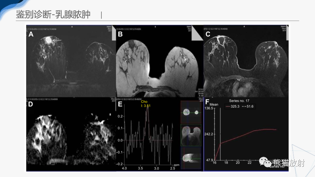 影像PPT - 【病例】乳腺粘液癌2例MR影像-37