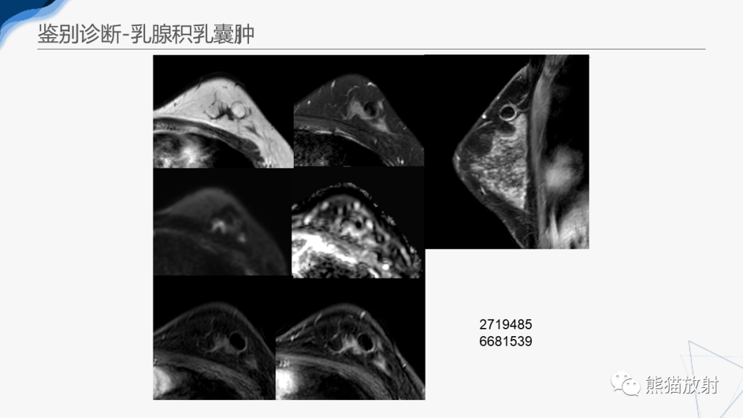 影像PPT - 【病例】乳腺粘液癌2例MR影像-39
