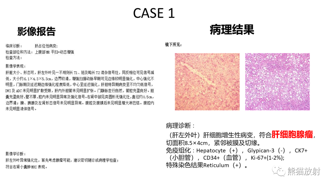 影像PPT - 【病例】肝细胞腺瘤 VS 纤维板层型肝癌-16