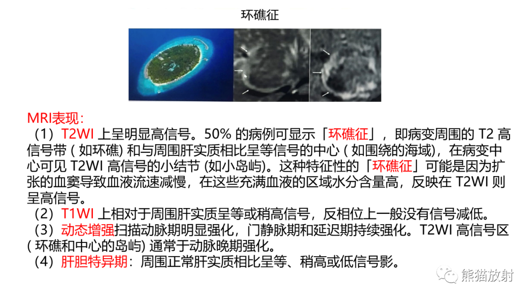 影像PPT - 【病例】肝细胞腺瘤 VS 纤维板层型肝癌-21