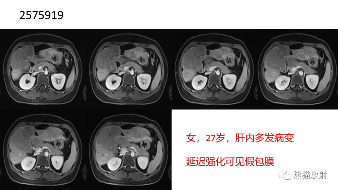 影像PPT - 【病例】肝细胞腺瘤 VS 纤维板层型肝癌-25