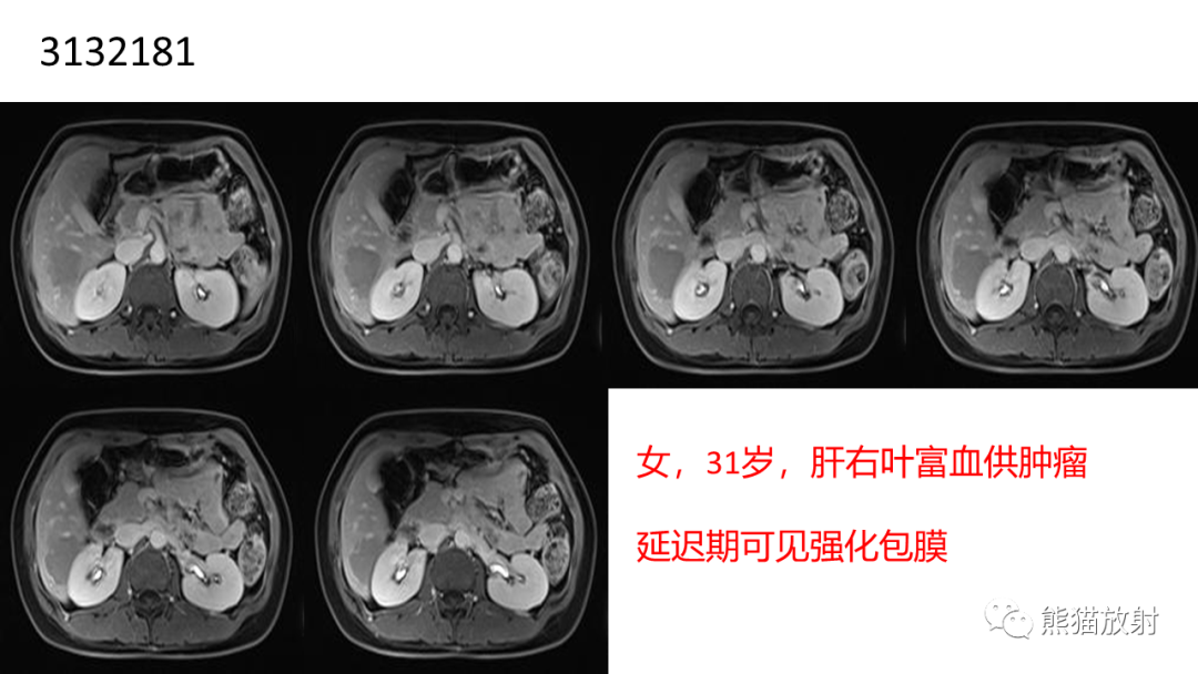 影像PPT - 【病例】肝细胞腺瘤 VS 纤维板层型肝癌-26