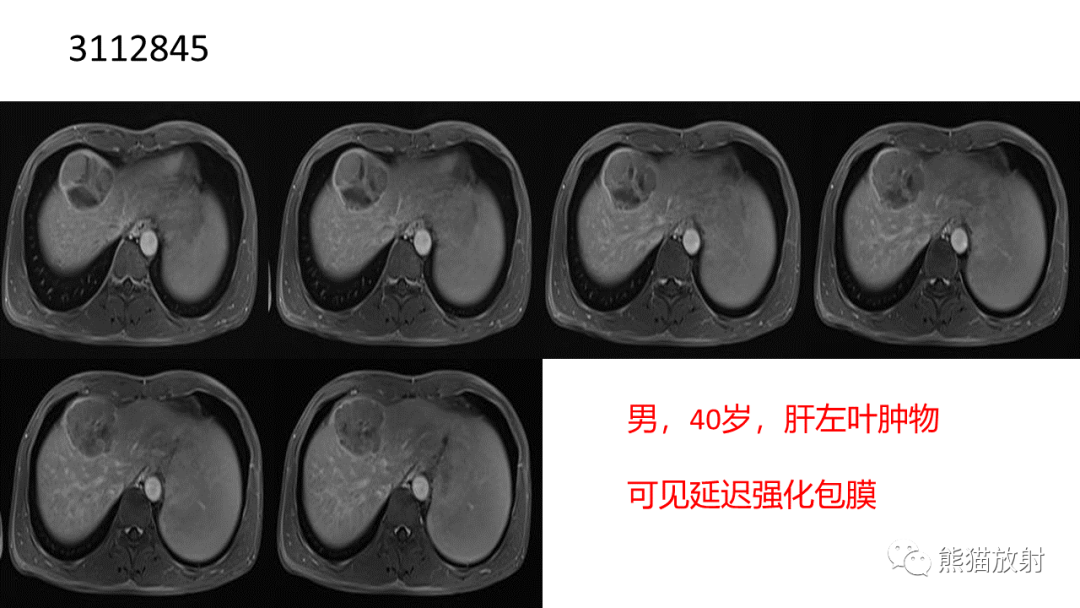 影像PPT - 【病例】肝细胞腺瘤 VS 纤维板层型肝癌-28