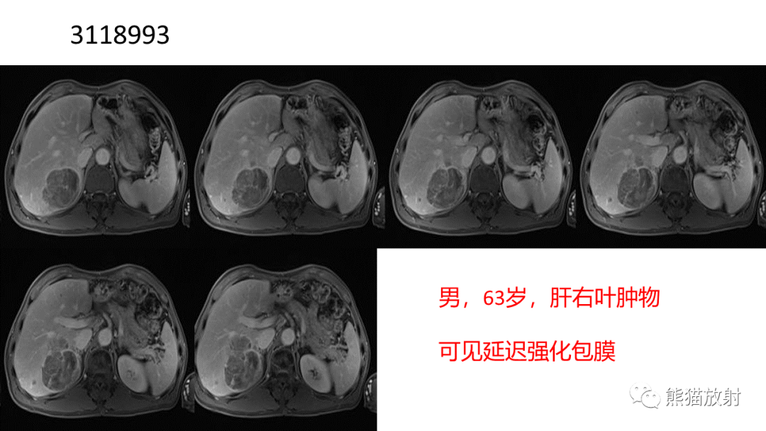 影像PPT - 【病例】肝细胞腺瘤 VS 纤维板层型肝癌-29