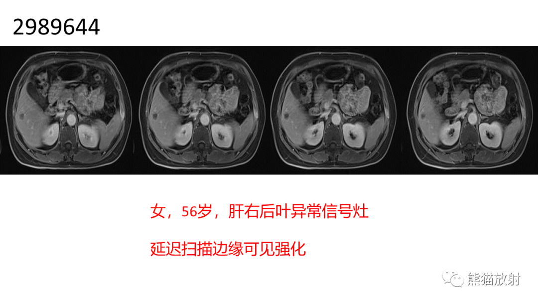 影像PPT - 【病例】肝细胞腺瘤 VS 纤维板层型肝癌-33