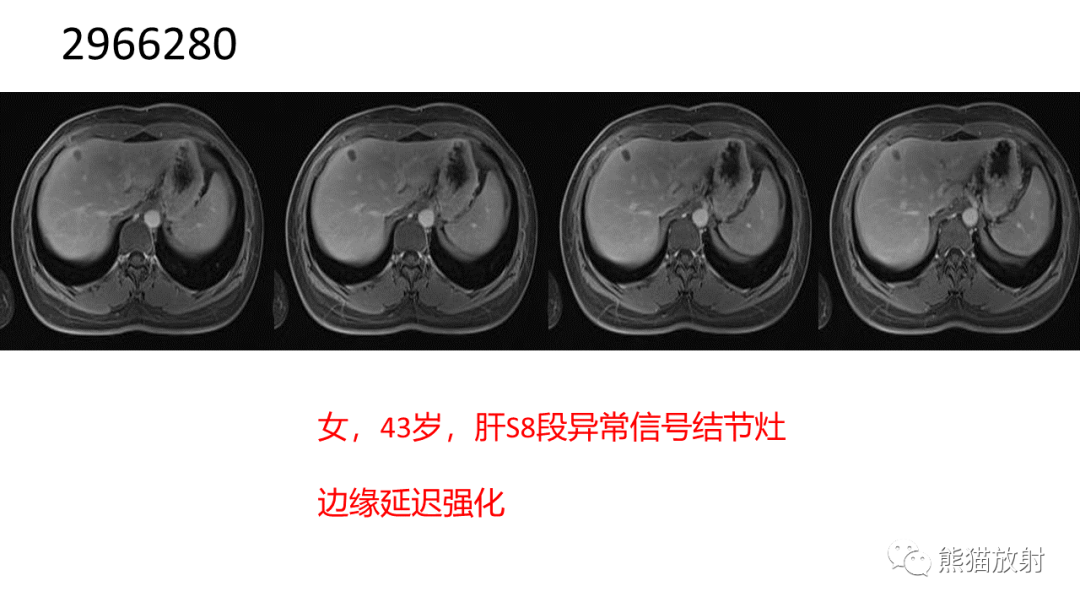 影像PPT - 【病例】肝细胞腺瘤 VS 纤维板层型肝癌-32