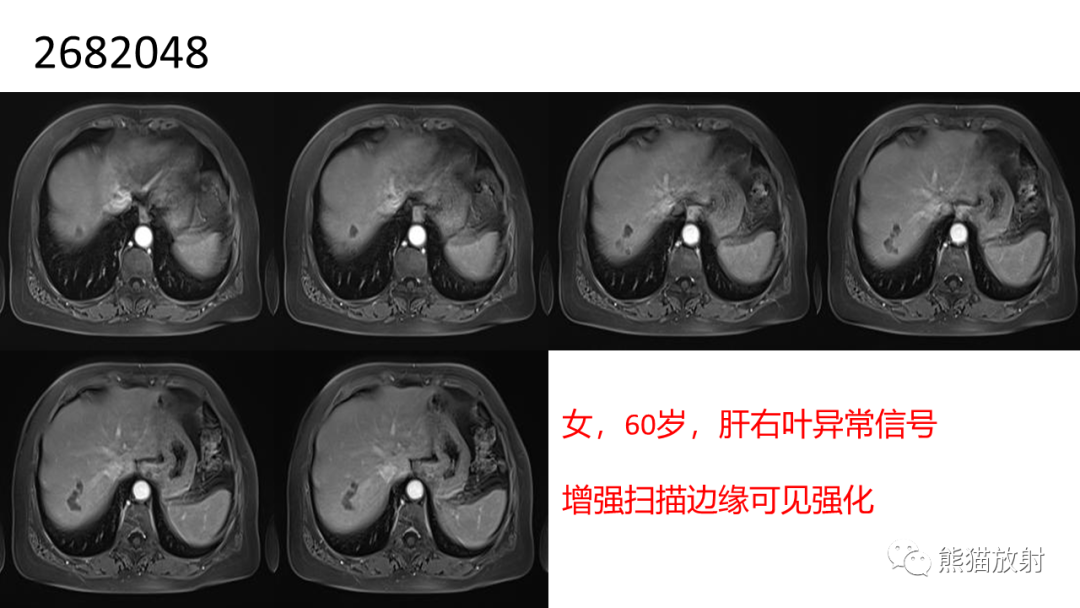 影像PPT - 【病例】肝细胞腺瘤 VS 纤维板层型肝癌-34