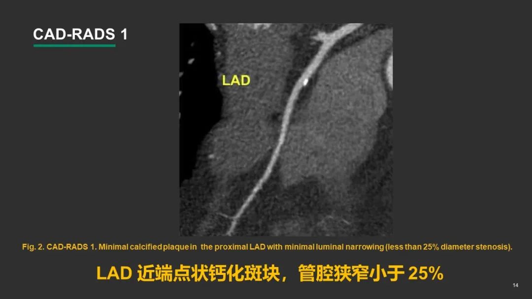 影像PPT - 【PPT】冠脉CAD-RADS分级系统解读-14