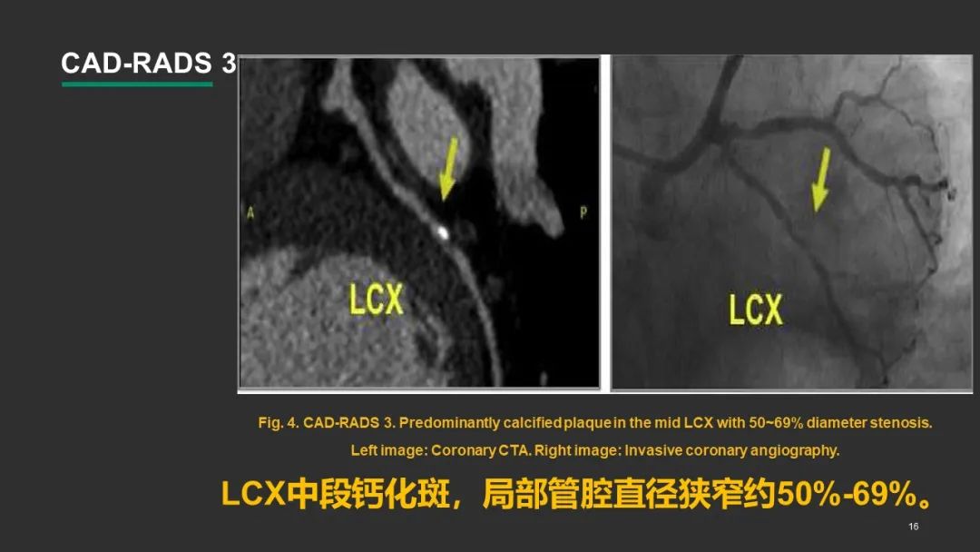 影像PPT - 【PPT】冠脉CAD-RADS分级系统解读-16