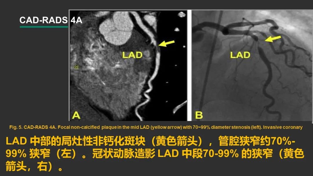 影像PPT - 【PPT】冠脉CAD-RADS分级系统解读-17