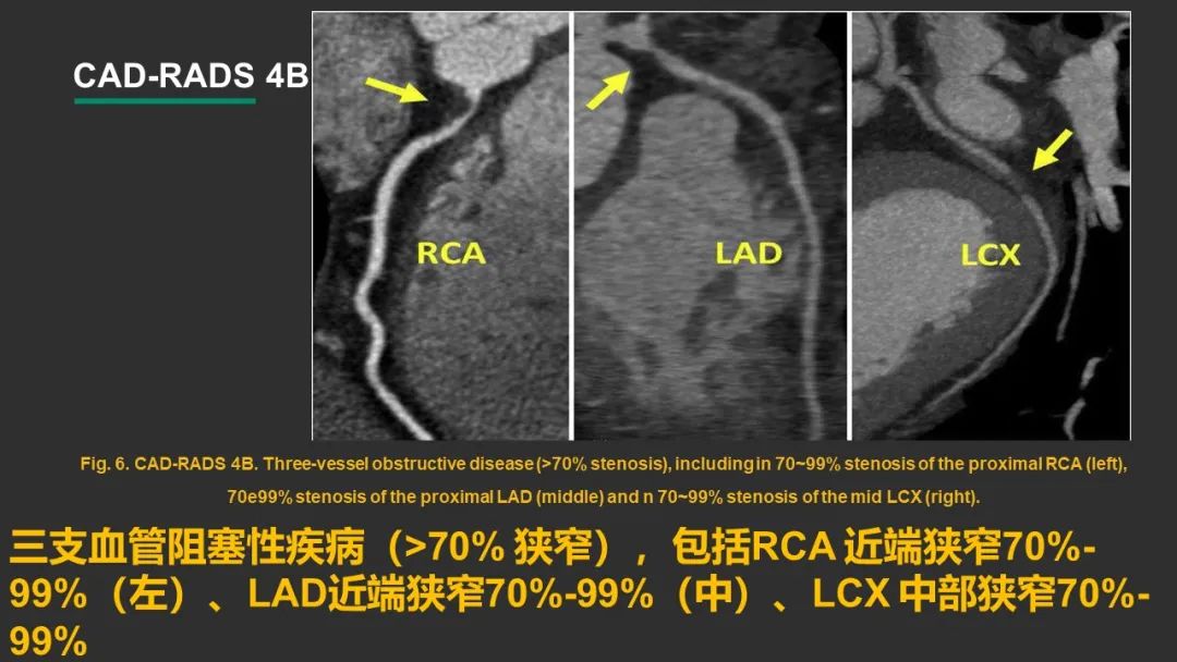 影像PPT - 【PPT】冠脉CAD-RADS分级系统解读-18