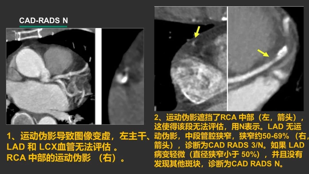 影像PPT - 【PPT】冠脉CAD-RADS分级系统解读-24