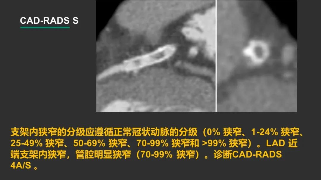 影像PPT - 【PPT】冠脉CAD-RADS分级系统解读-26
