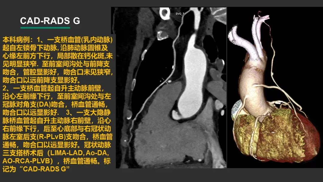 影像PPT - 【PPT】冠脉CAD-RADS分级系统解读-28