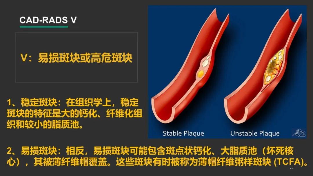 影像PPT - 【PPT】冠脉CAD-RADS分级系统解读-29