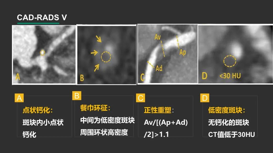影像PPT - 【PPT】冠脉CAD-RADS分级系统解读-30
