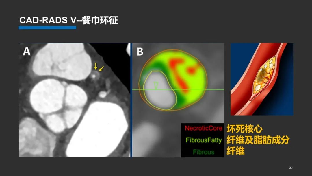 影像PPT - 【PPT】冠脉CAD-RADS分级系统解读-32