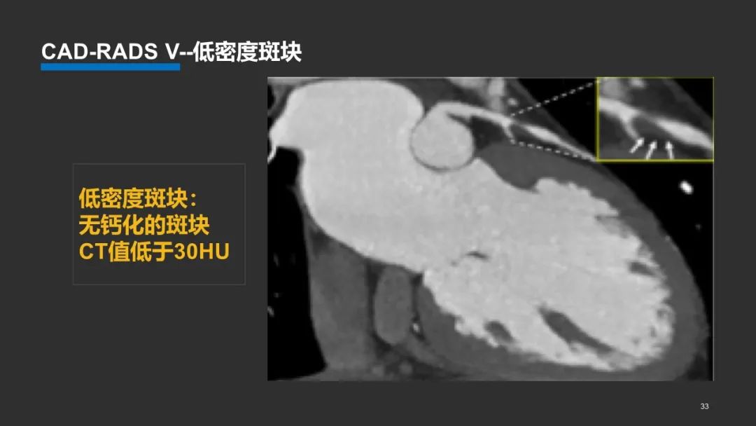影像PPT - 【PPT】冠脉CAD-RADS分级系统解读-33