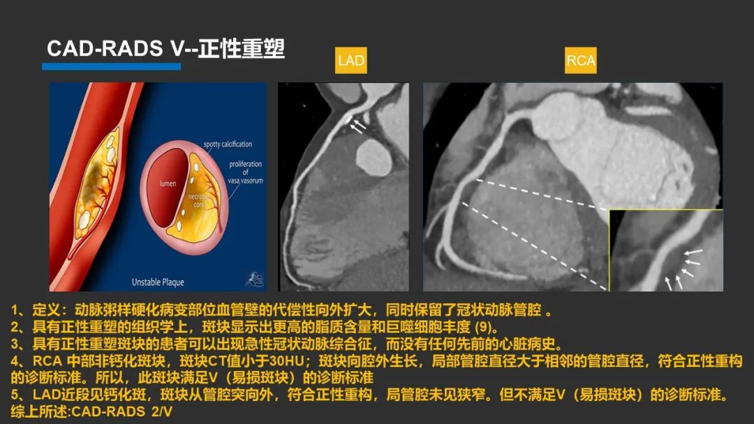 影像PPT - 【PPT】冠脉CAD-RADS分级系统解读-34