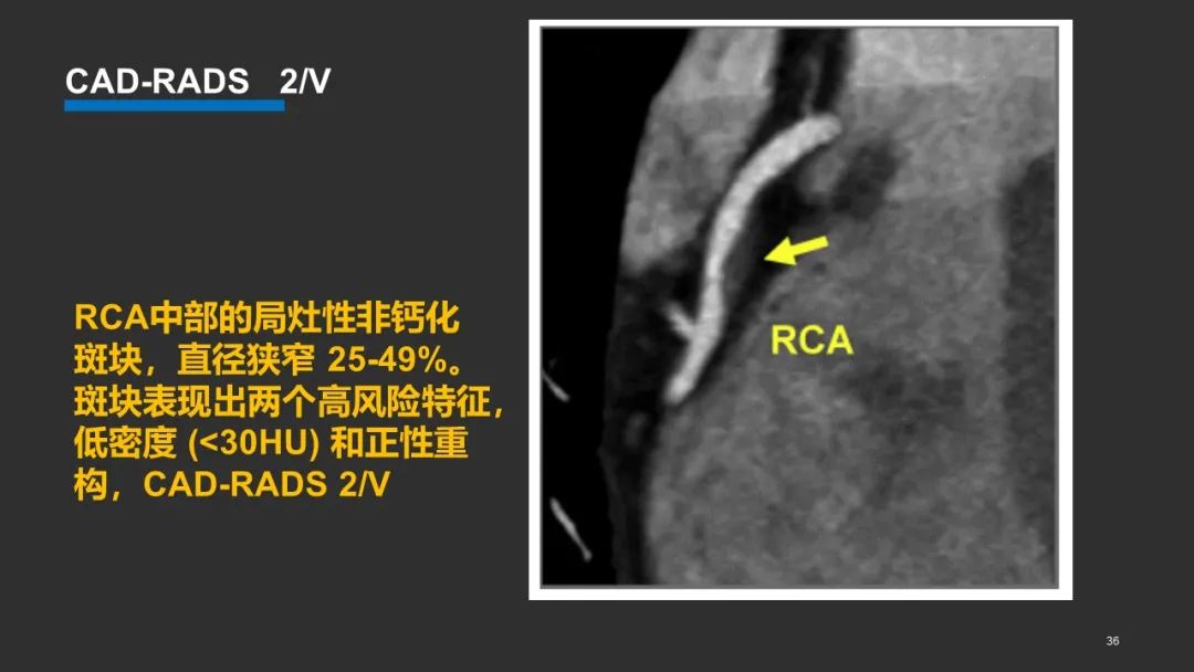 影像PPT - 【PPT】冠脉CAD-RADS分级系统解读-35