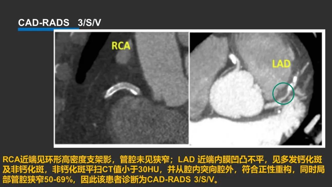 影像PPT - 【PPT】冠脉CAD-RADS分级系统解读-36