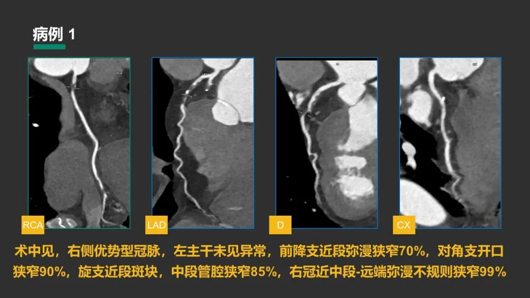 影像PPT - 【PPT】冠脉CAD-RADS分级系统解读-39