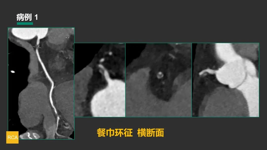 影像PPT - 【PPT】冠脉CAD-RADS分级系统解读-41