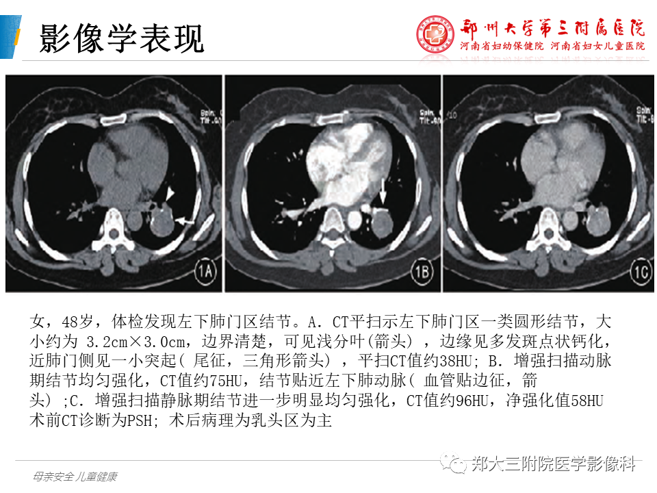 影像PPT - 【PPT】硬化性肺泡细胞瘤的影像学表现-8