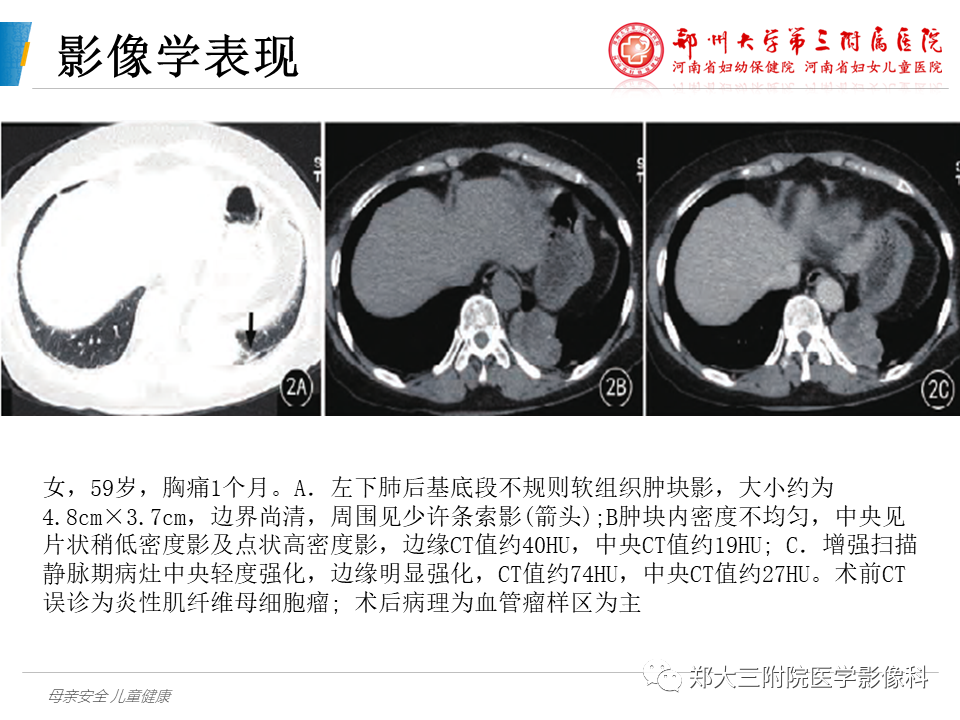 影像PPT - 【PPT】硬化性肺泡细胞瘤的影像学表现-9