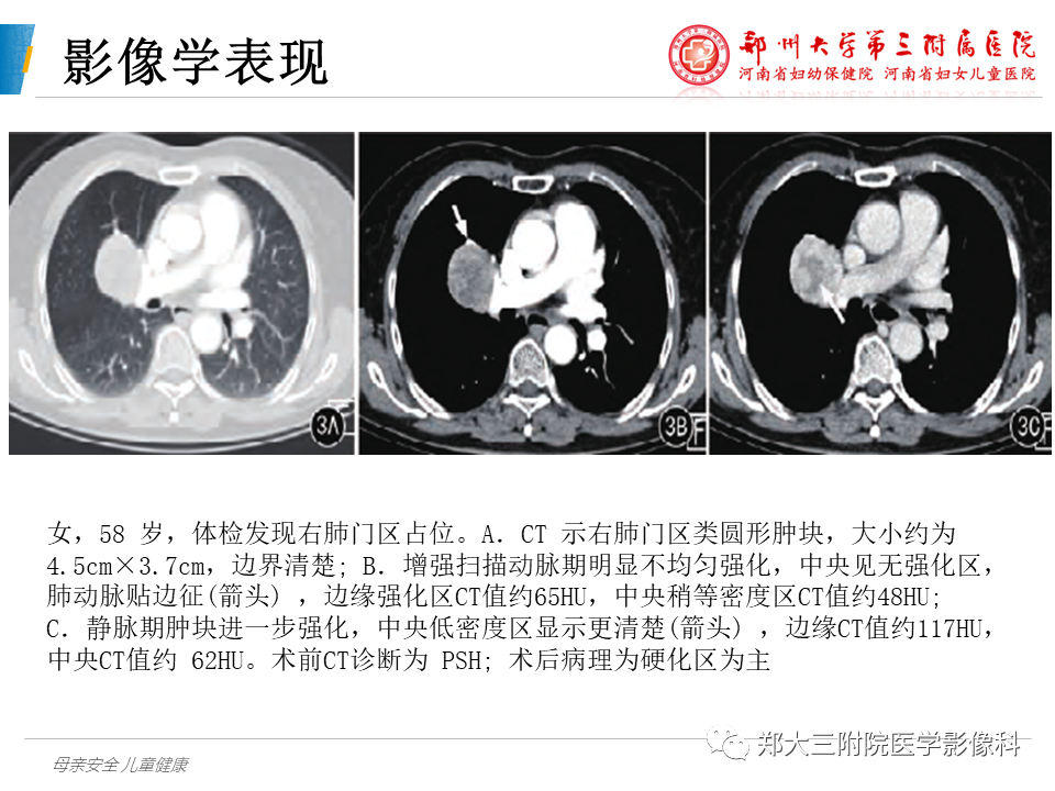 影像PPT - 【PPT】硬化性肺泡细胞瘤的影像学表现-10