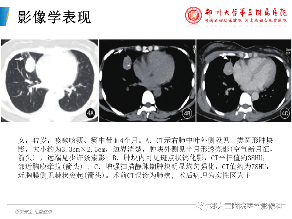 影像PPT - 【PPT】硬化性肺泡细胞瘤的影像学表现-11