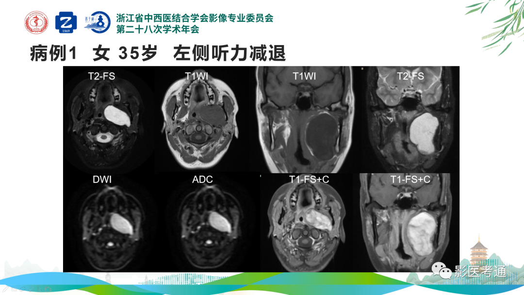 影像PPT - 【PPT】咽旁间隙病变定位与常见肿瘤性病变影像诊断-2 影像PPT - 【PPT】咽旁间隙病变定位与常见肿瘤性病变影像诊断-2