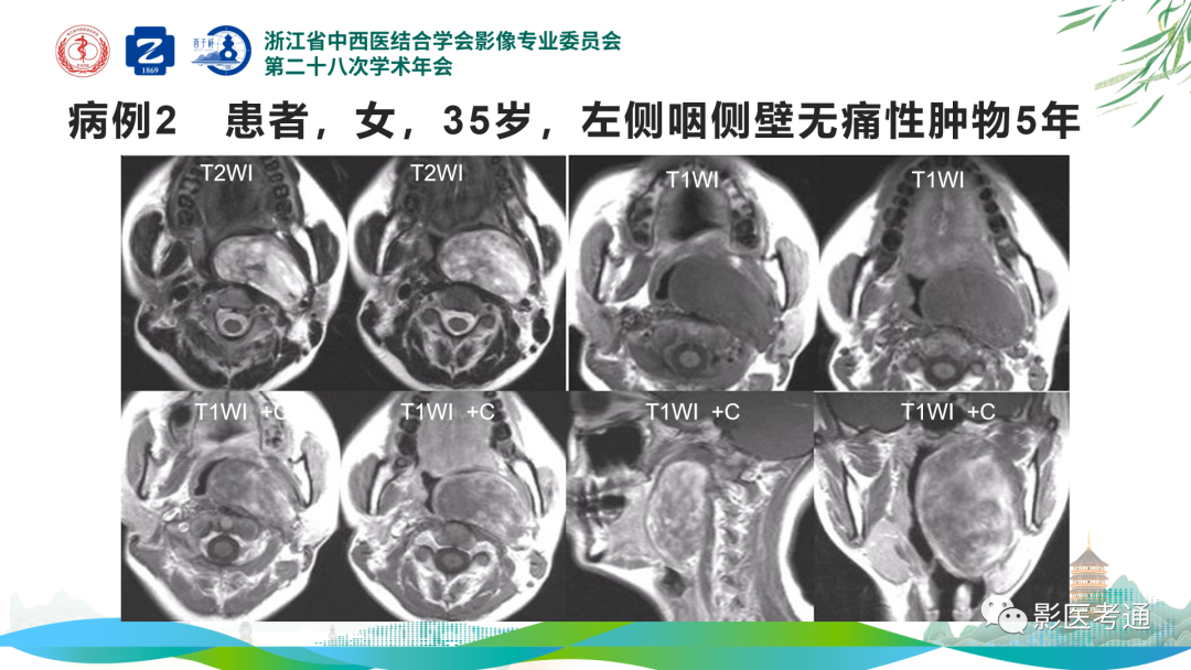 影像PPT - 【PPT】咽旁间隙病变定位与常见肿瘤性病变影像诊断-3 影像PPT - 【PPT】咽旁间隙病变定位与常见肿瘤性病变影像诊断-3