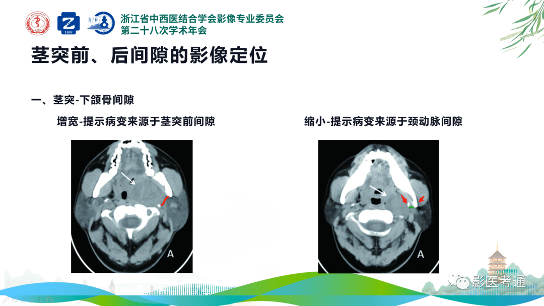 影像PPT - 【PPT】咽旁间隙病变定位与常见肿瘤性病变影像诊断-7 影像PPT - 【PPT】咽旁间隙病变定位与常见肿瘤性病变影像诊断-7