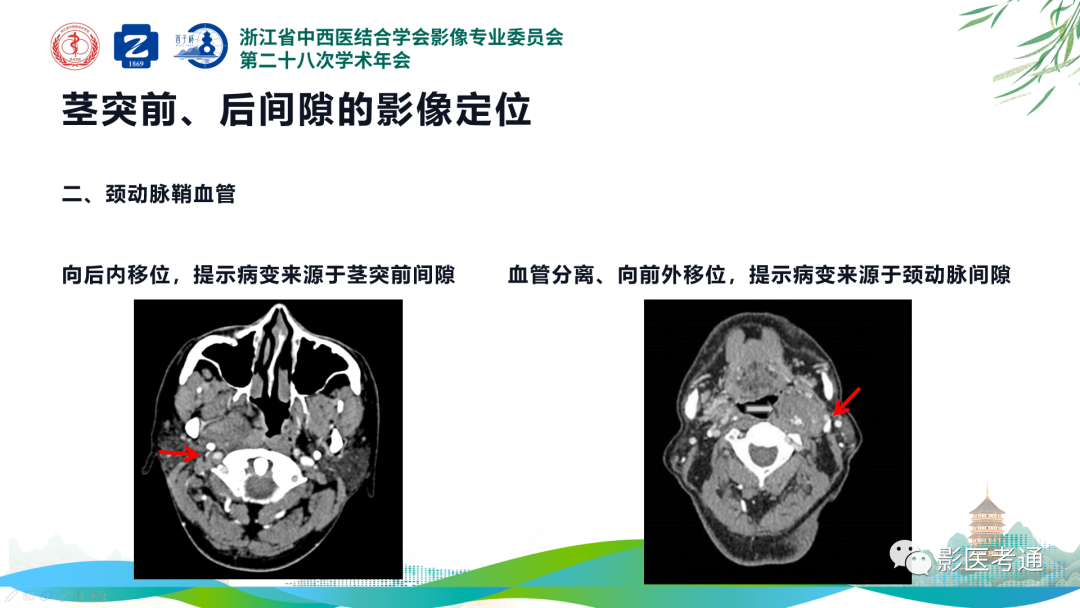 影像PPT - 【PPT】咽旁间隙病变定位与常见肿瘤性病变影像诊断-8 影像PPT - 【PPT】咽旁间隙病变定位与常见肿瘤性病变影像诊断-8
