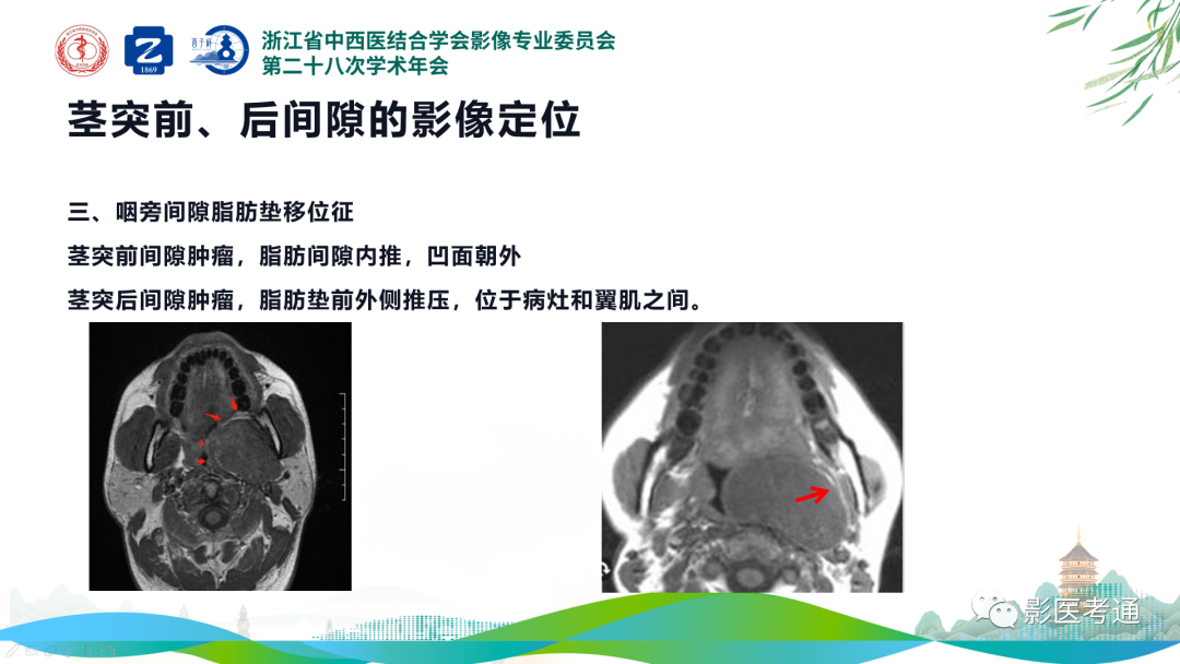 影像PPT - 【PPT】咽旁间隙病变定位与常见肿瘤性病变影像诊断-9 影像PPT - 【PPT】咽旁间隙病变定位与常见肿瘤性病变影像诊断-9