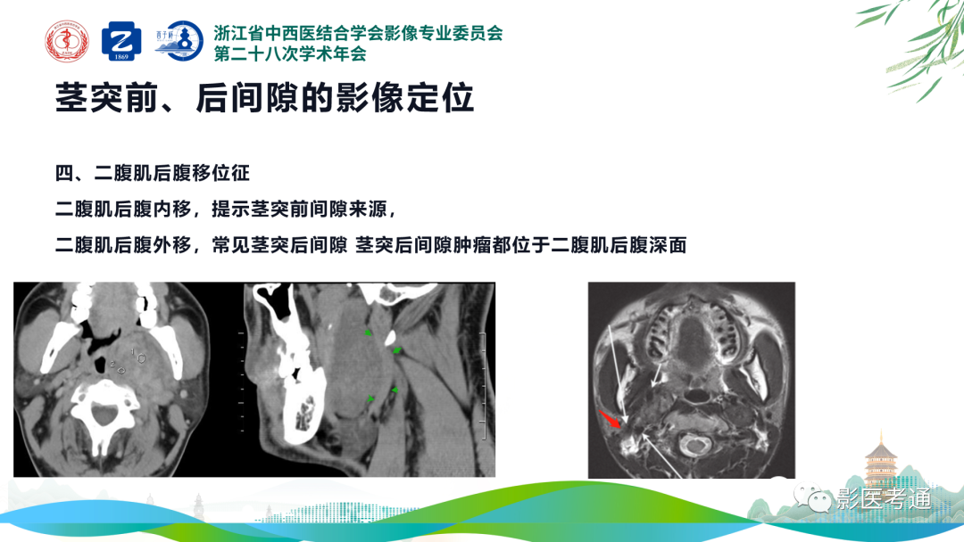 影像PPT - 【PPT】咽旁间隙病变定位与常见肿瘤性病变影像诊断-10 影像PPT - 【PPT】咽旁间隙病变定位与常见肿瘤性病变影像诊断-10