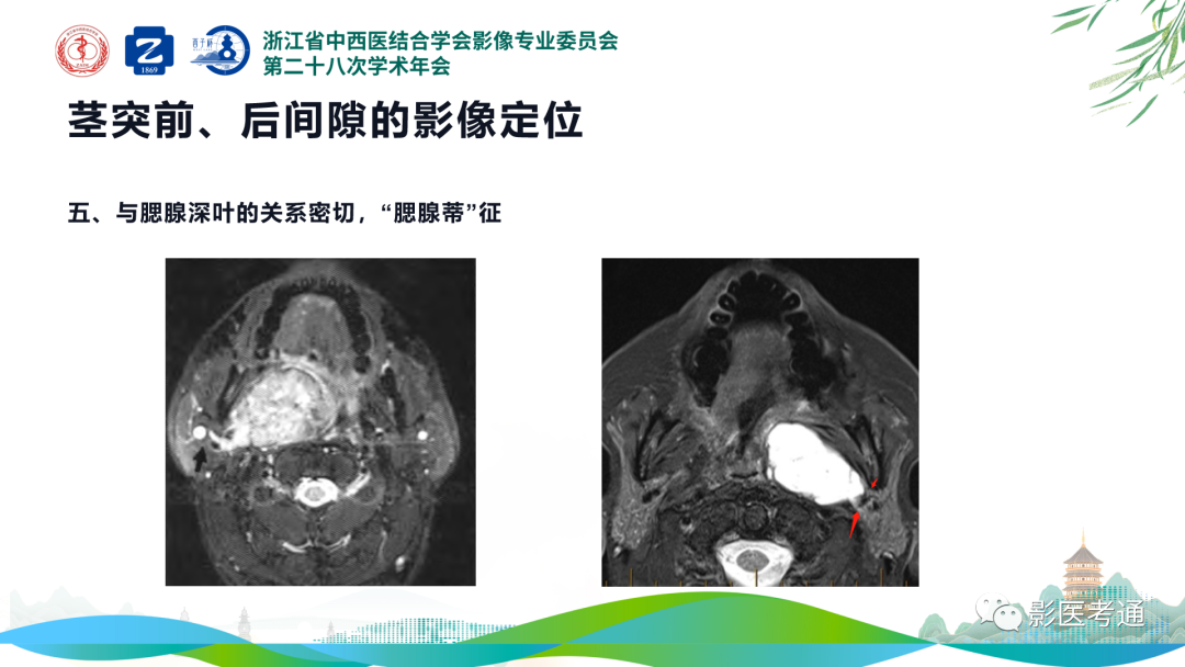 影像PPT - 【PPT】咽旁间隙病变定位与常见肿瘤性病变影像诊断-11 影像PPT - 【PPT】咽旁间隙病变定位与常见肿瘤性病变影像诊断-11