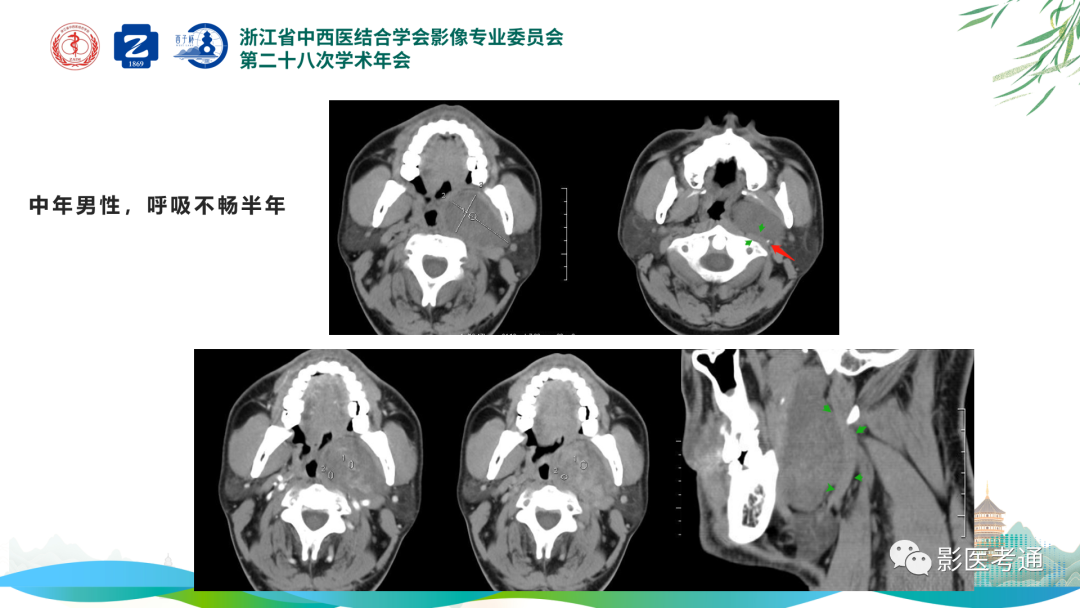 影像PPT - 【PPT】咽旁间隙病变定位与常见肿瘤性病变影像诊断-14 影像PPT - 【PPT】咽旁间隙病变定位与常见肿瘤性病变影像诊断-14