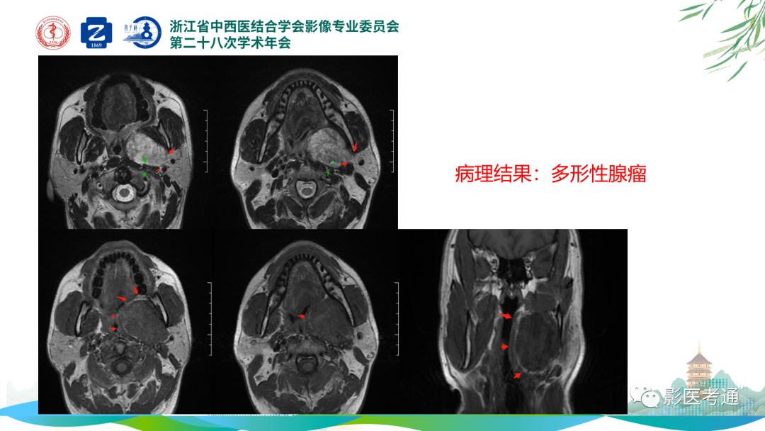 影像PPT - 【PPT】咽旁间隙病变定位与常见肿瘤性病变影像诊断-15 影像PPT - 【PPT】咽旁间隙病变定位与常见肿瘤性病变影像诊断-15